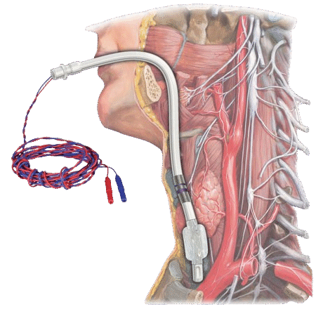 Laryngeal Electrode